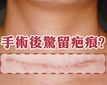 手術後驚留疤痕？只要配合配得好，平疤淡印無煩惱！